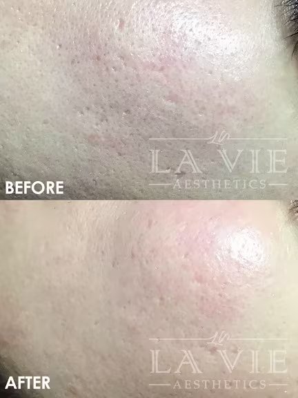 ="MRF MRF (RF Microneedling) Promotion